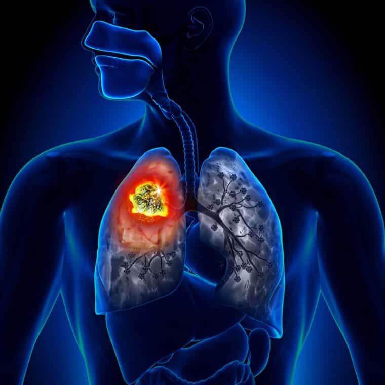 lung cancer